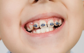 乳牙还没换完，要不要做早期矫正？